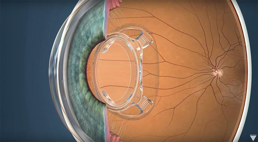 A New Bionic Lens Could Take Place of Glasses and Contact Lenses?