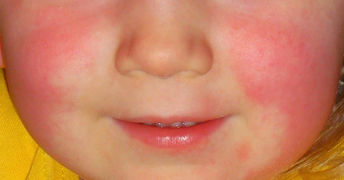 Scarlet Fever Returns and Here Are the Warning Signs You Must Know