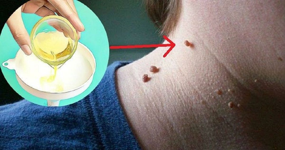 Get Rid Of Fibroma & Other Skin Warts With This One Ingredient